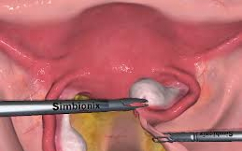 Professional Diploma in Basic Laparoscopic Surgery (MIS) for Gynecologist - Module I